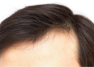 M型发际线是如何形成的 如何有效改善M型脱发