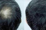 头顶脱发做植发需要多少钱 头发加密后还会再掉吗