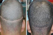 疤痕植发效果自然么 佛山广大壹美医疗美容疤痕植发贵吗