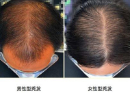 头发加密种植多久能看到效果 种植后的护理真的重要吗