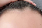 发际线种植有风险吗 沈阳博士园发际线种植术安全性如何