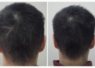 造成头顶头发稀疏的因素 郑州华山头发加密的技术好吗