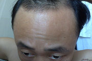 发际线偏高可以通过植发手术来改善吗 种植手术效果好不好