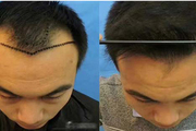 如何正确保护发际线呢 发际线种植手术具有什么特点
