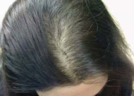 苏州新生植发医院加密种植头发价格多少 有什么副作用吗