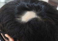疤痕植发的手术效果如何 造成疤痕脱发的原因有哪些