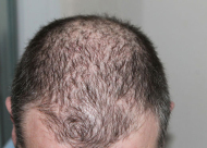 男性秃顶形成的主要原因有哪些 头发加密手术有哪些特点