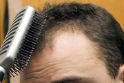 发际线调整术安全性如何 正规植发医院发际线调整需要多少钱