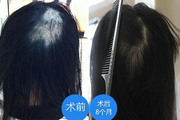 如何去掉头发里面的疤痕 疤痕植发的价格及影响因素