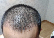 头发局部稀少是怎么回事 天津新发现加密种植好吗