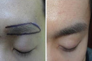 眉毛种植适合什么样的人 上海艺星医院眉毛种植术的成功率高吗