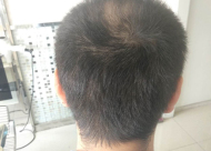 头顶头发少可以植发吗 温州建国植发医院加密种植哪些优点