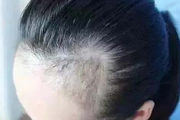 发际线调整会留下疤痕吗 调整的注意事项有哪些