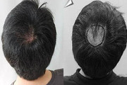 疤痕植发的采用什么原理 手术的注意事项都有哪些呢