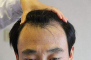 发际线种植危害有哪些 发际线修复手术技术介绍