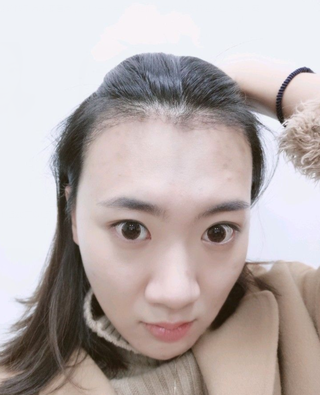 发际线_美人尖怎么样_术后第61天效果图_爱你我怕了的植发日记_求发网